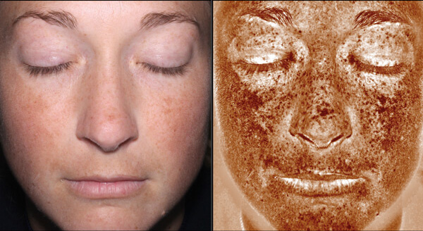 Îmbătrânire cauzată de expunerea solară